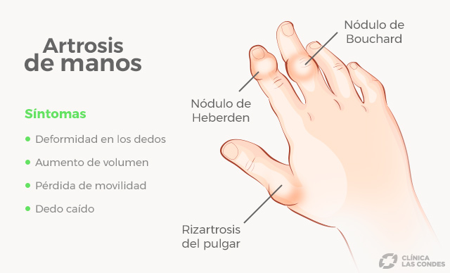 Artrosis de manos