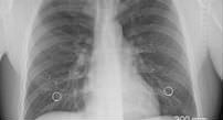 Disco pulmonar